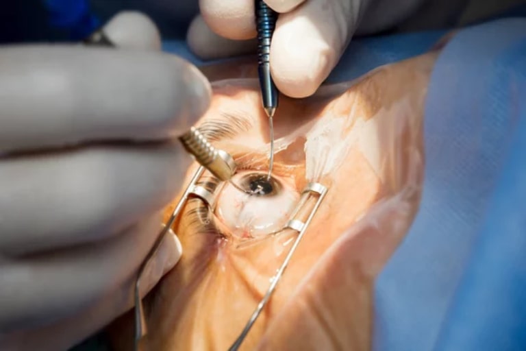 cataract surgery in shamshabad